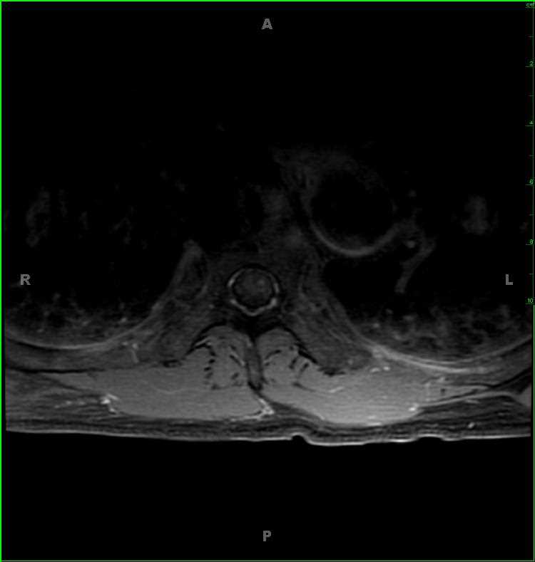 Thoracic Spinal Cord Cavernoma - CTisus CT Scan