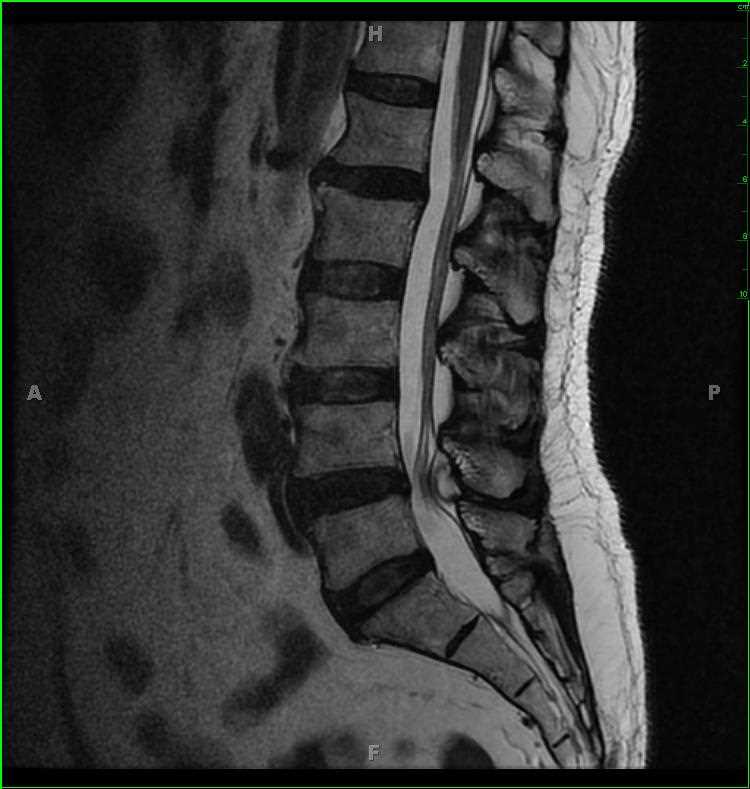 synovial cyst spine