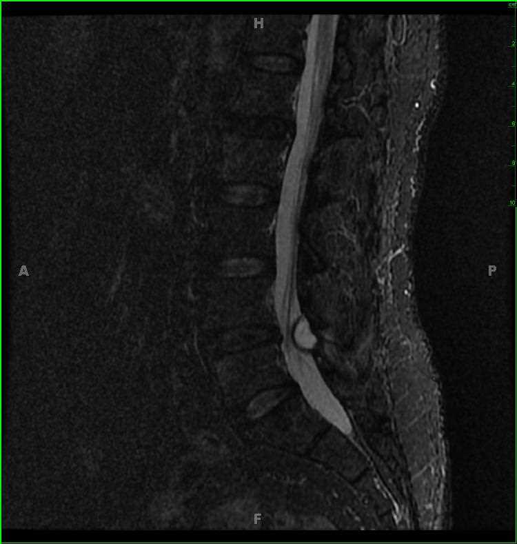 Lumbar Spine Synovial Cyst Neuro Mr Case Studies Ctisus Ct Scanning