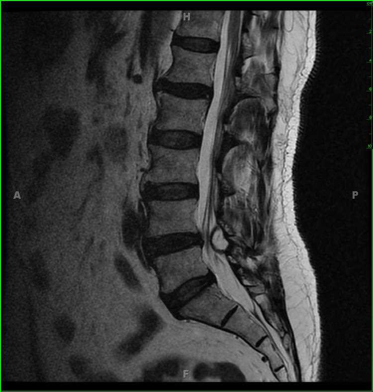 spinal fluid image