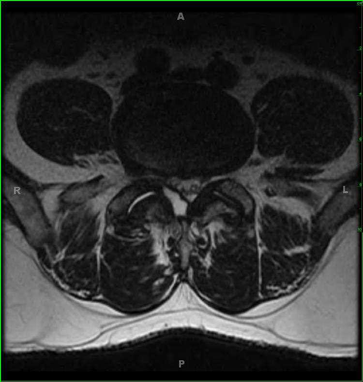 Lumbar Spine Synovial Cyst - CTisus CT Scan