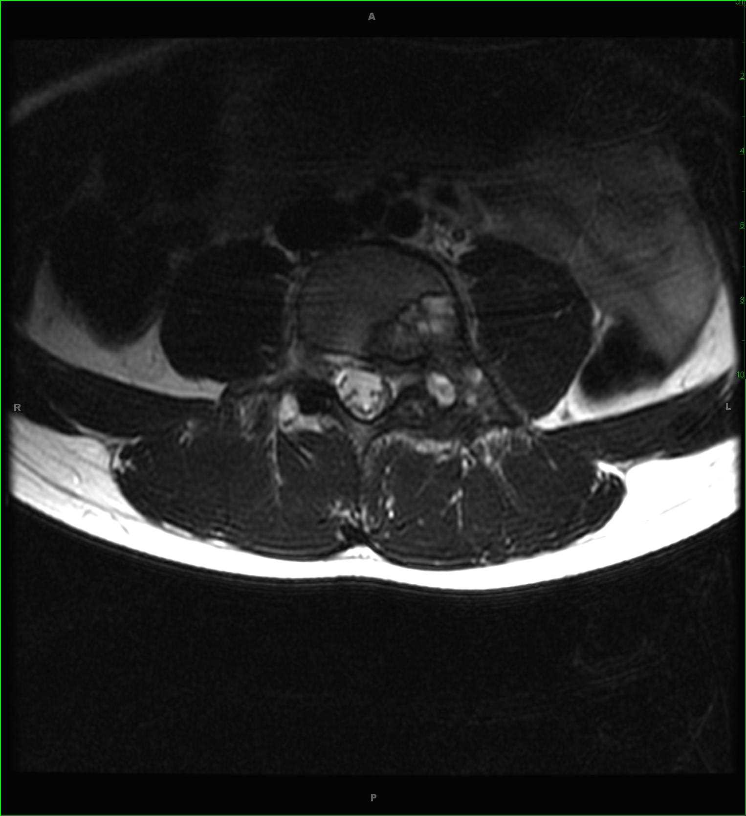 Aneurysmal Bone Cyst, secondary to osteoblastoma - CTisus CT Scan