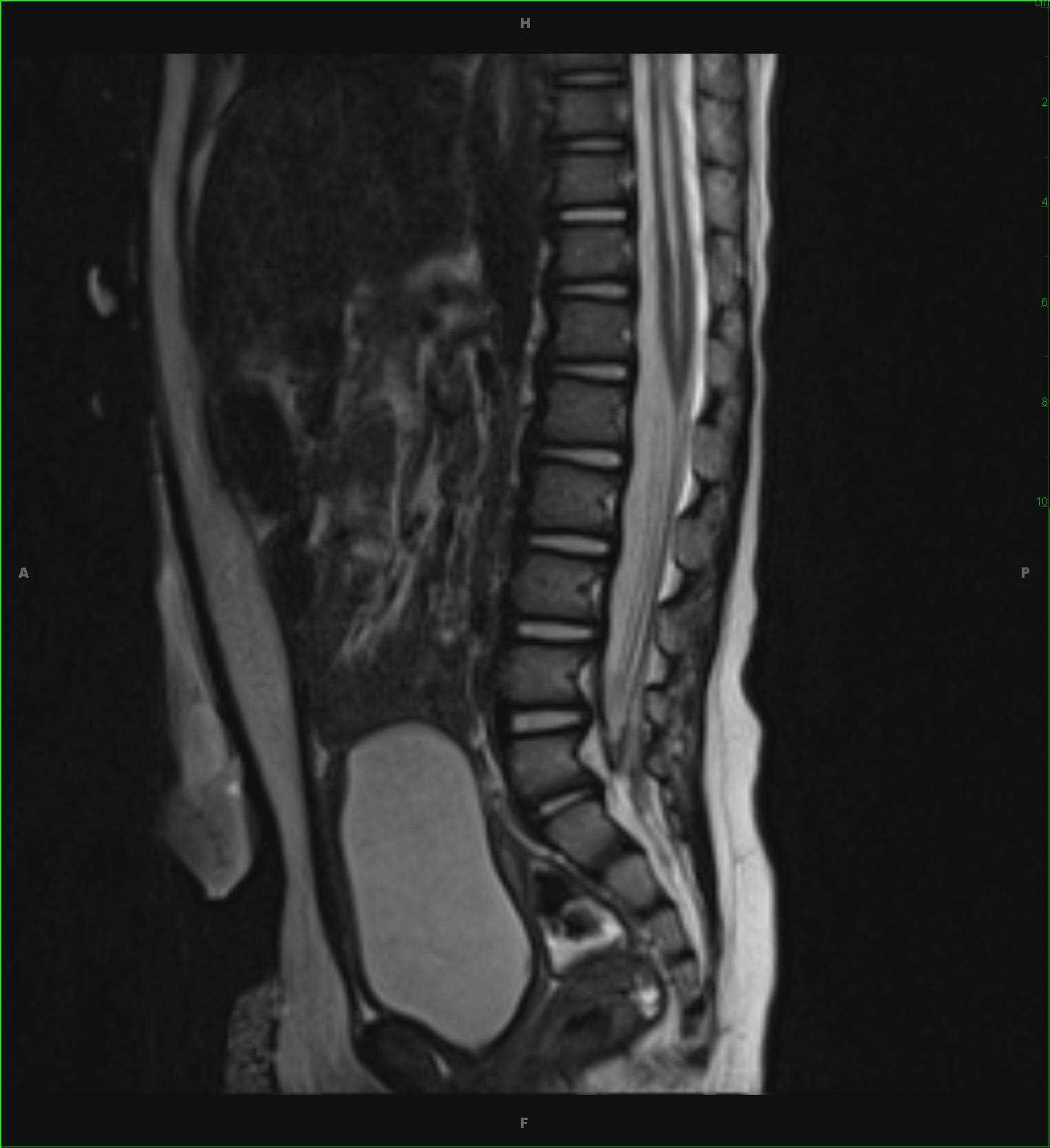 Medulloblastoma and Syrinx - CTisus CT Scan