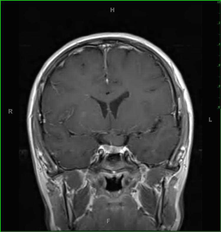 Neurofibromatosis Type 1 - CTisus CT Scan