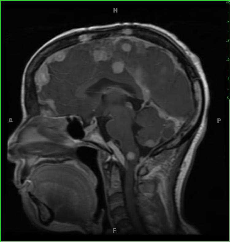 Neurofibromatosis Type 2 - CTisus CT Scan