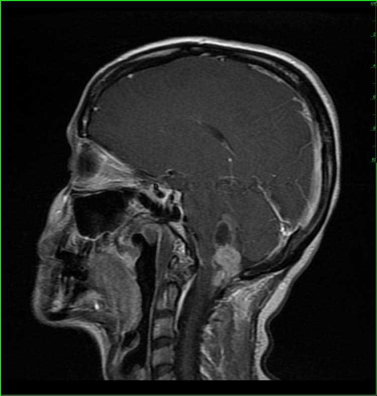 Anaplastic Ependymoma - CTisus CT Scan