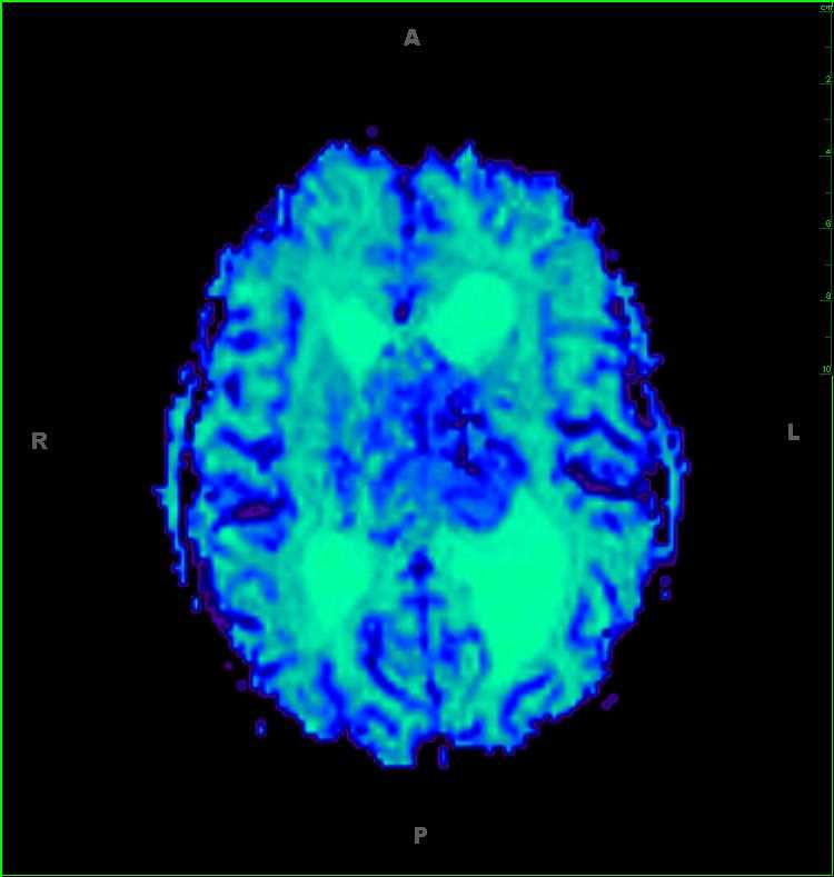 Atypical Neurocytoma - CTisus CT Scan