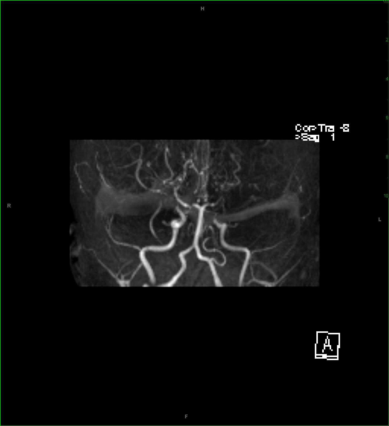 Moyamoya, primary - CTisus CT Scan