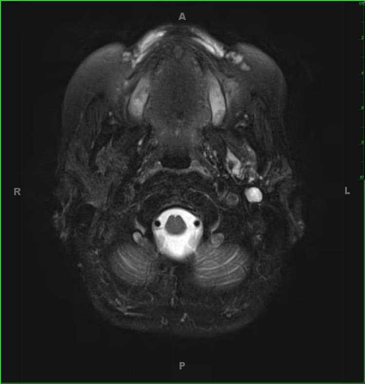 Warthins Tumor - CTisus CT Scan