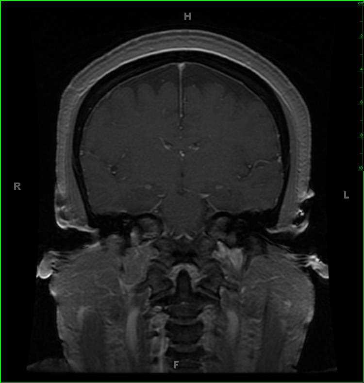 Jugular Foramen Schwannoma, right - CTisus CT Scan