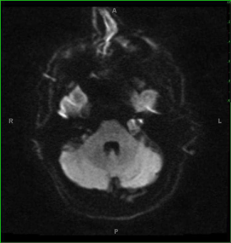 Vestibular Schwannoma, left - Neuro MR Case Studies - CTisus CT Scanning