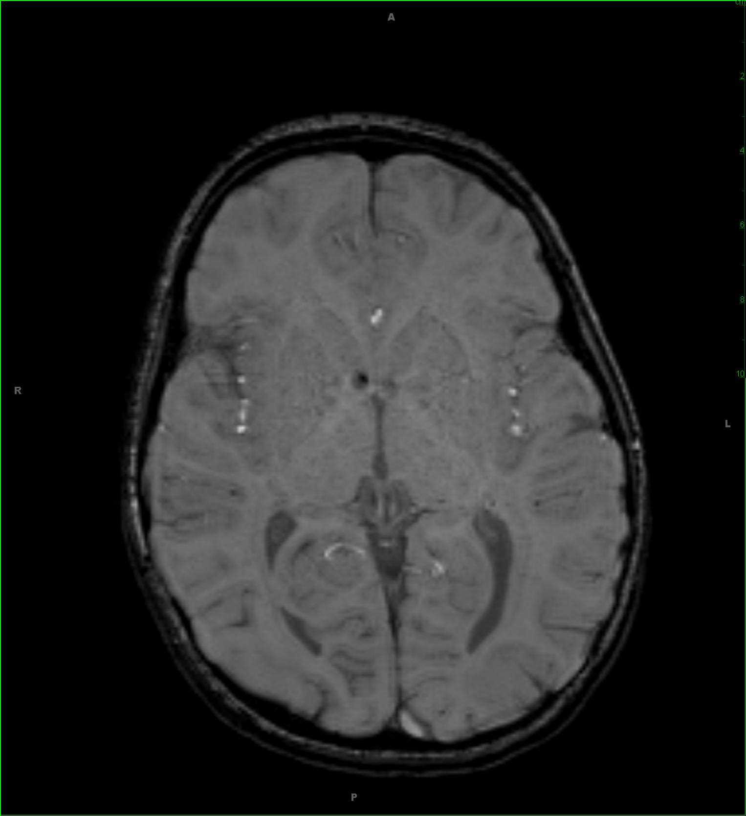 Tuberous Sclerosis - CTisus CT Scan