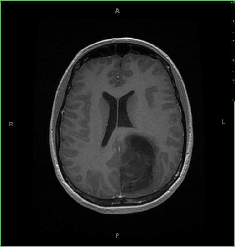 Anaplastic Astrocytoma - CTisus CT Scan