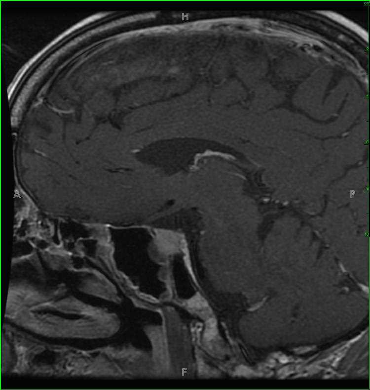 Pituitary Macroadenoma - CTisus CT Scan