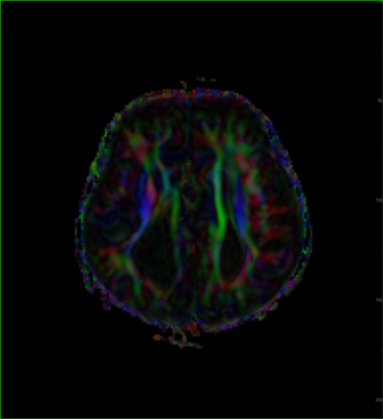 Callosal Agenesis - CTisus CT Scan