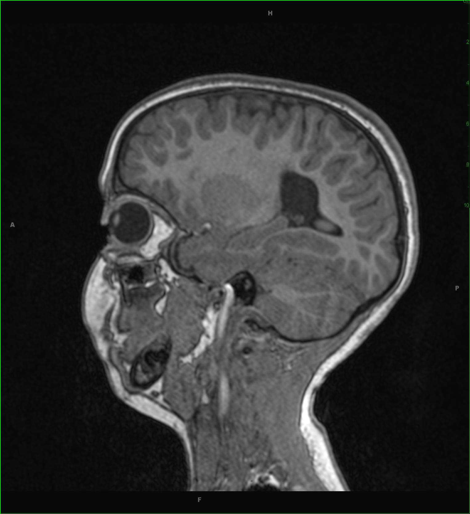 Periventricular White Matter Injury of Prematurity - CTisus CT Scan