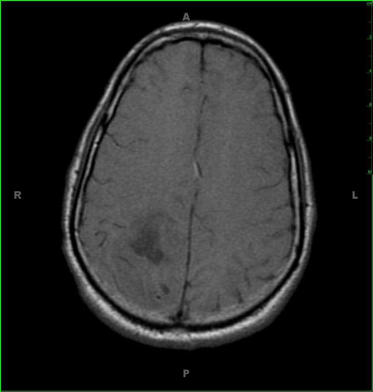 Oligodendroglioma - Neuro MR Case Studies - CTisus CT Scanning