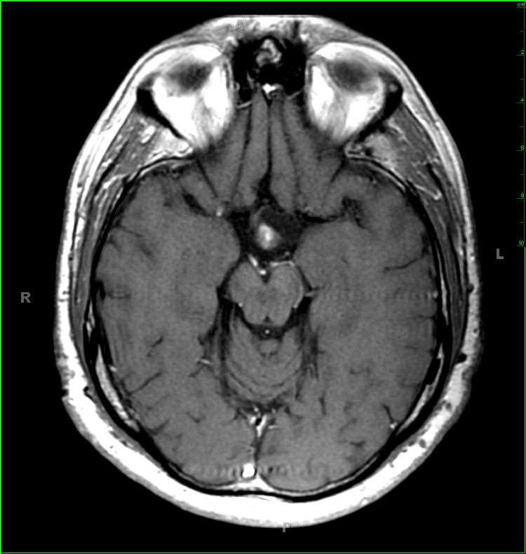 Hypothalamic Glioma in Neurofibromatosis Type I - CTisus CT Scan