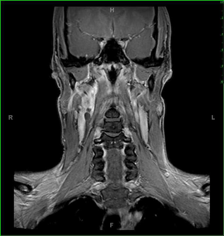 Vagal Schwannoma, right - CTisus CT Scan