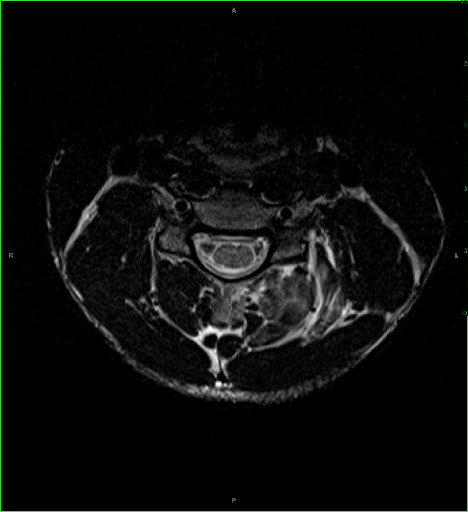 Cervical Sprain, including well defined muscle strains - CTisus CT Scan