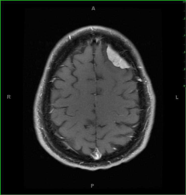 Meningioma, left frontal - CTisus CT Scan