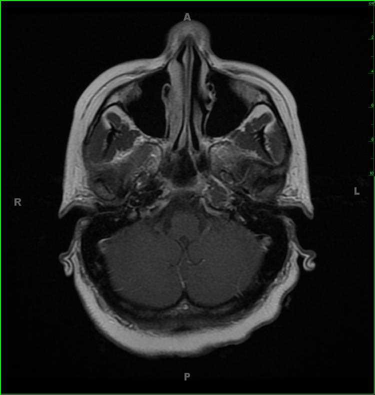 Petrous Apicitis, left - Neuro MR Case Studies - CTisus CT Scanning