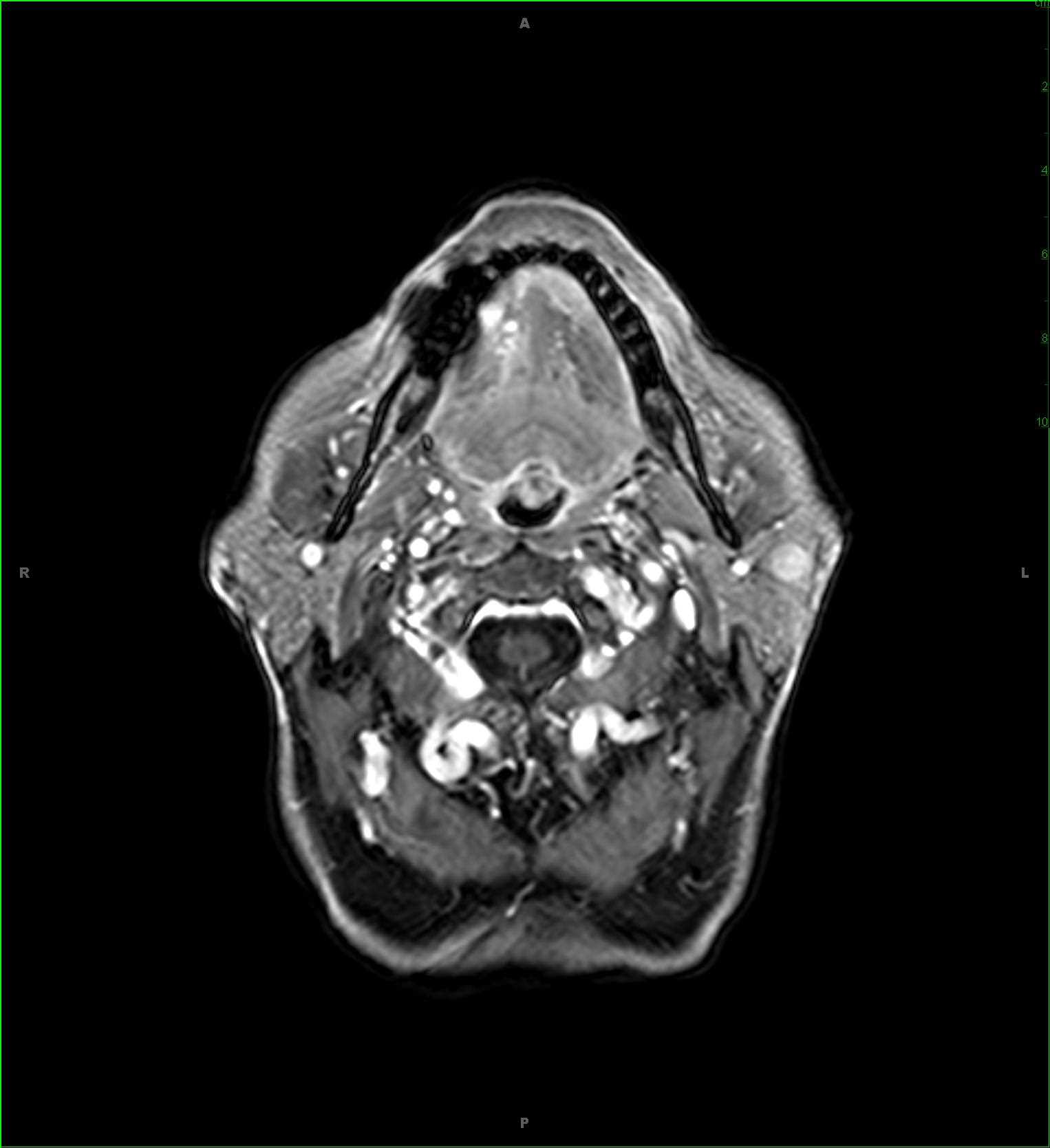 Left Parotid Oncocytoma - Neuro MR Case Studies - CTisus CT Scanning