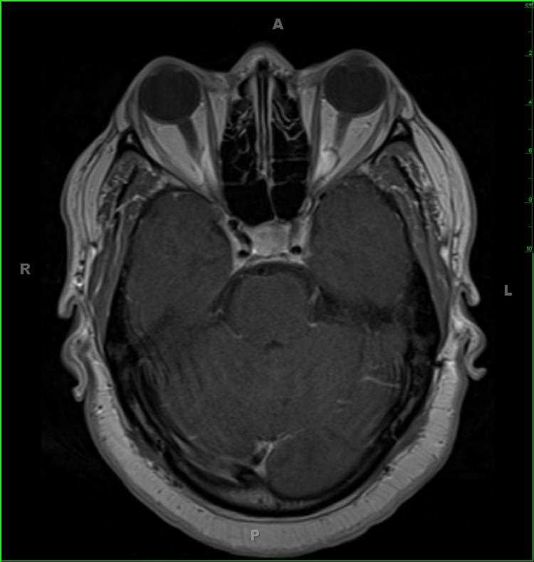 Rathkes Cleft Cyst - CTisus CT Scan