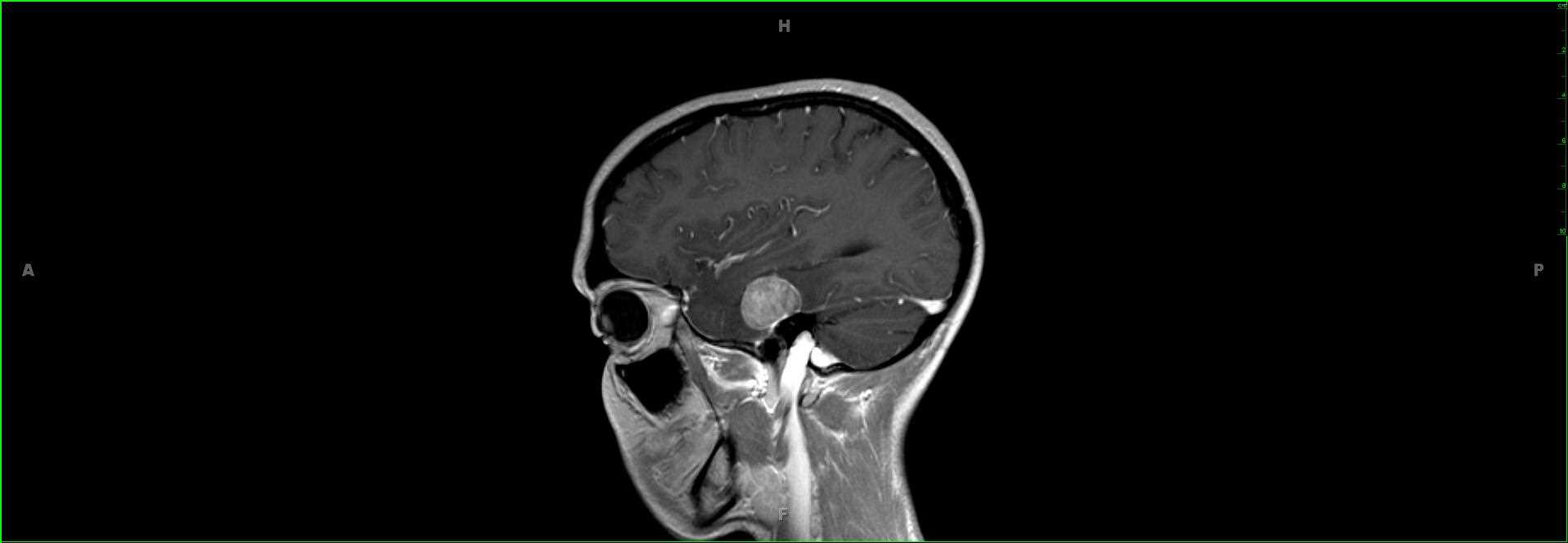 Disseminated Choroid Plexus Papilloma - CTisus CT Scan