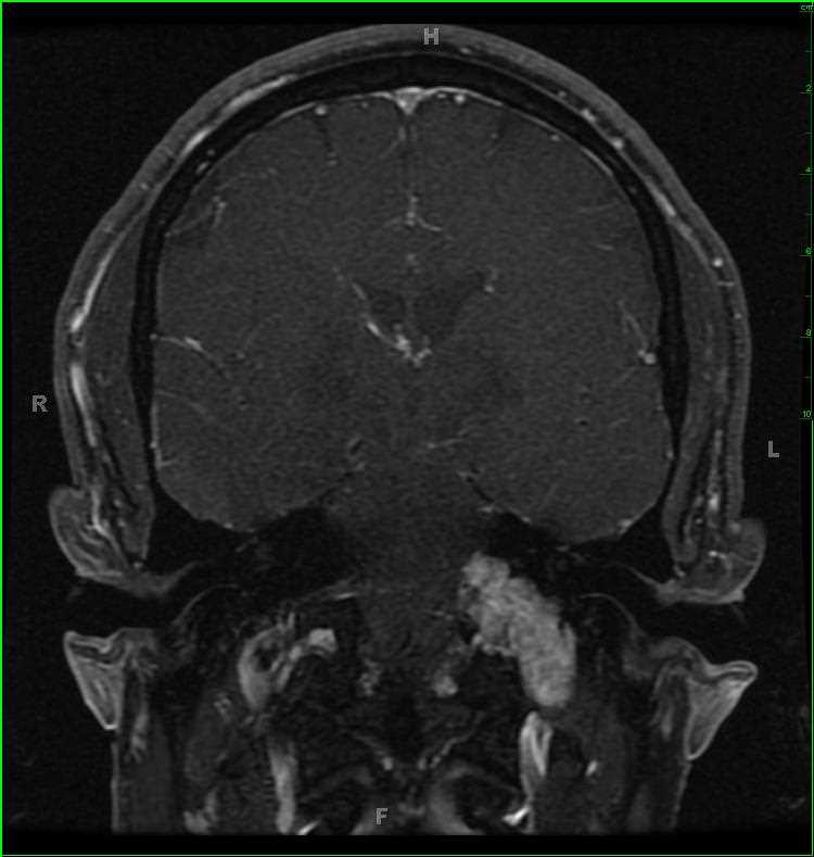 Jugular Foramen Schwannoma, left - CTisus CT Scan