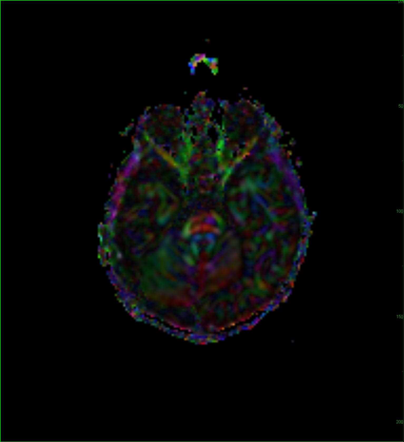 Old Right MCA Perinatal Infarct with Wallerian Degeneration - CTisus CT Scan