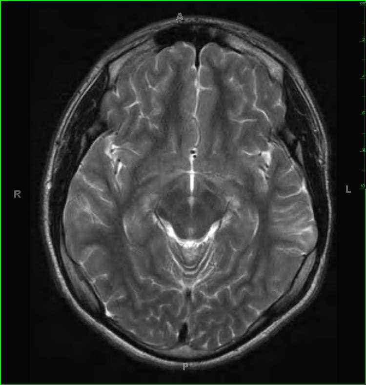 Cortical Dysplasia - CTisus CT Scan