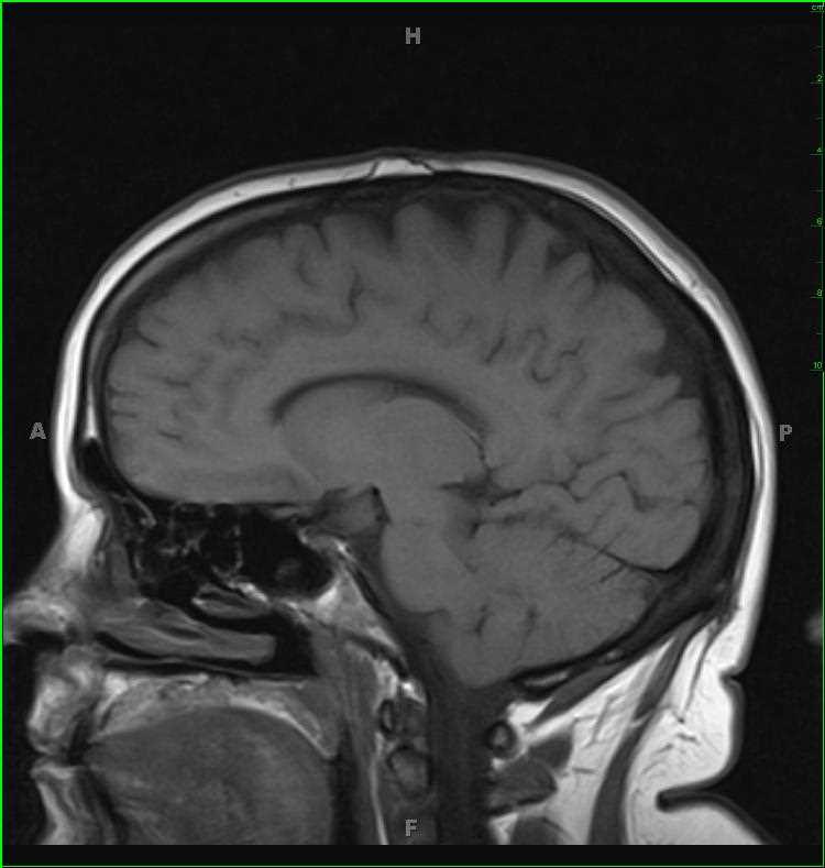 Scalp Fibrolipoma - CTisus CT Scan