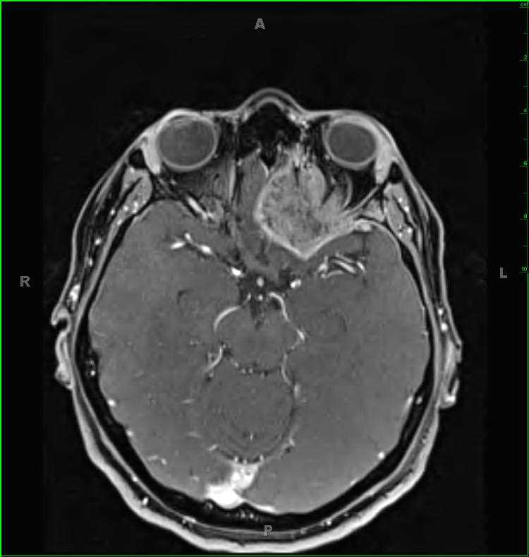 Midline Nut Carcinoma - CTisus CT Scan