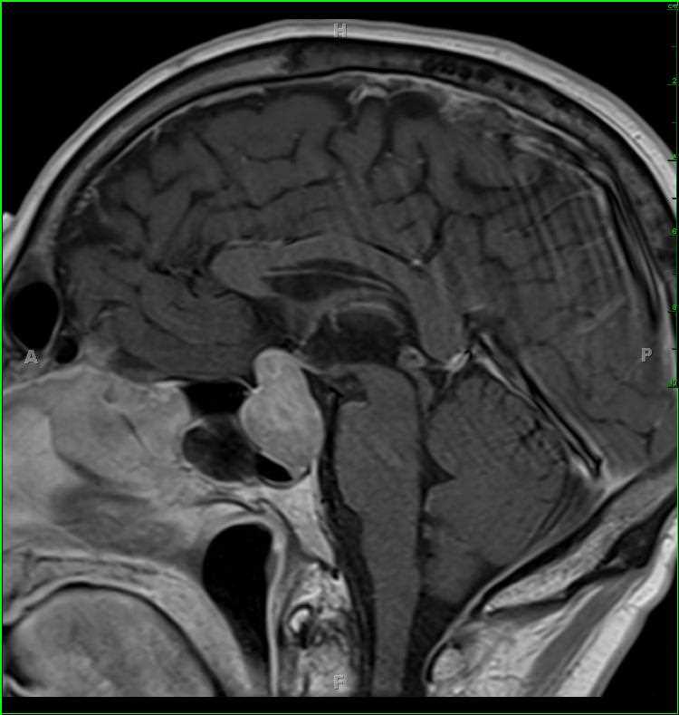 Pituicytoma - CTisus CT Scan