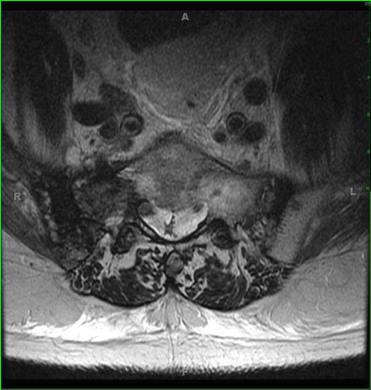 Pathologic Fractures, secondary to metastatic prostate cancer - CTisus CT Scan