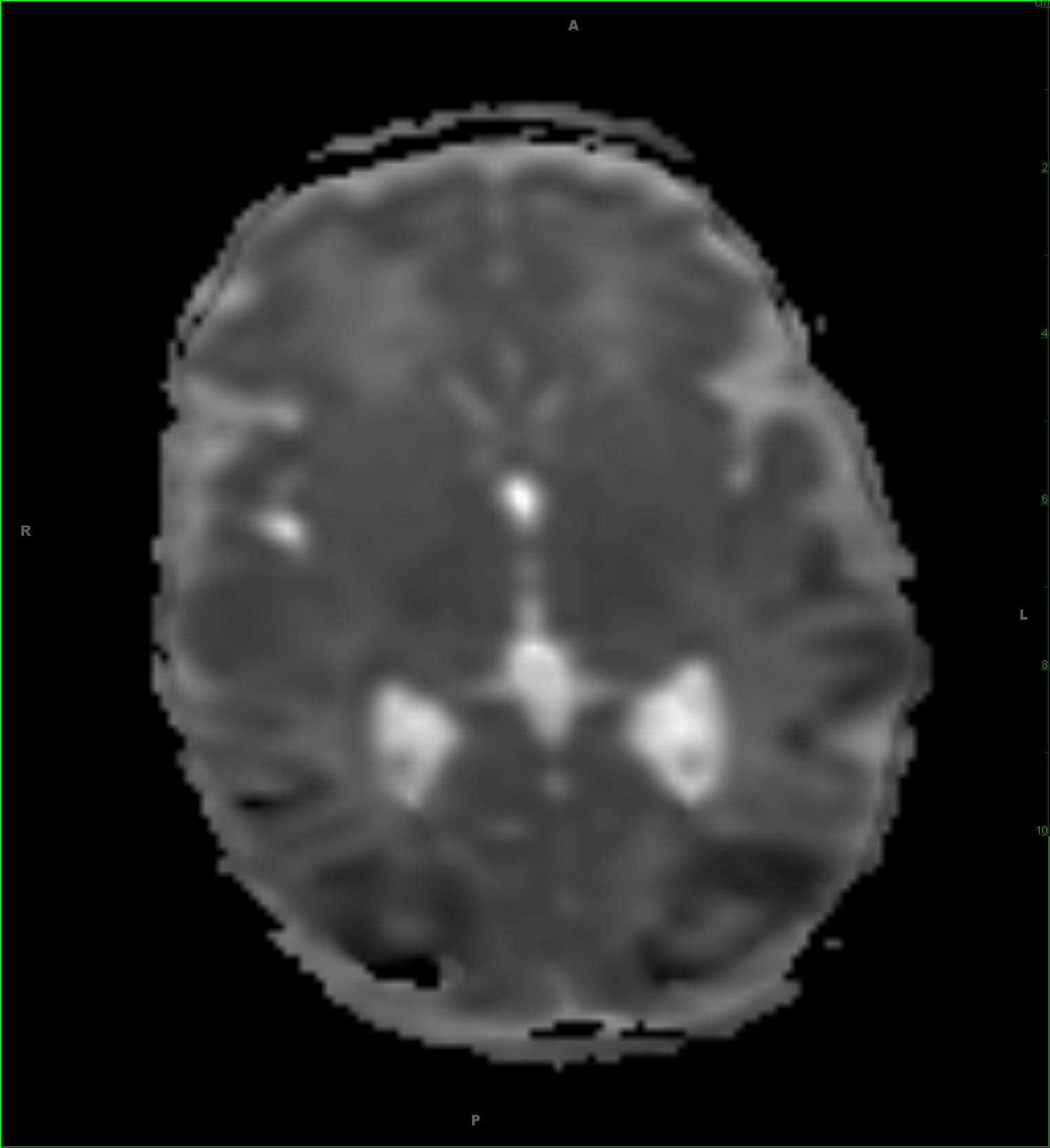 Perinatal Subdural and Parenchymal Hematomas, secondary to thrombocytopenia - CTisus CT Scan