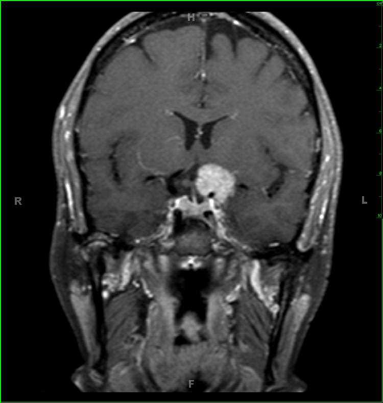 Meningioma, left anterior clinoid process - CTisus CT Scan