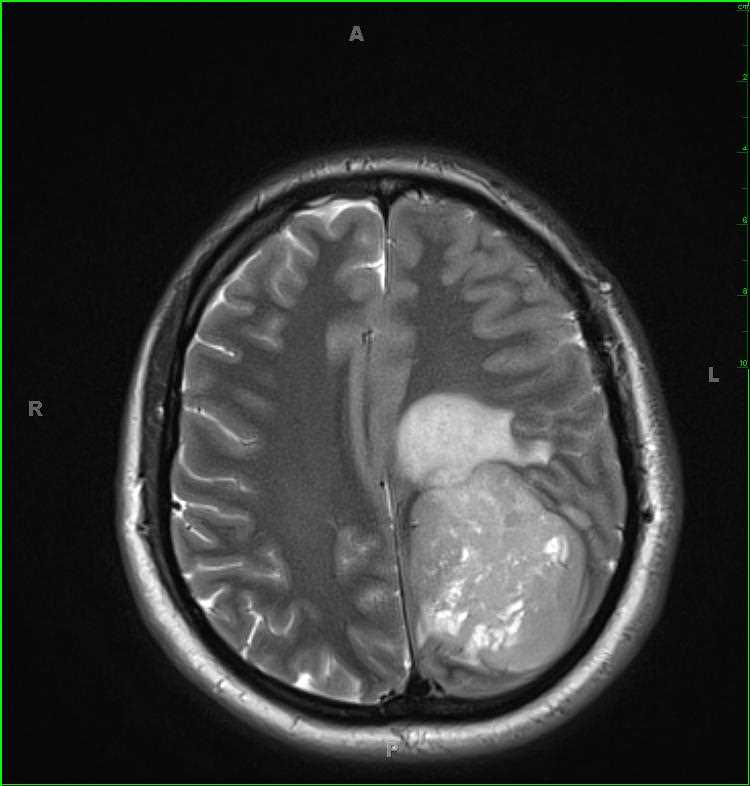 Ependymoma, supratentorial - CTisus CT Scan