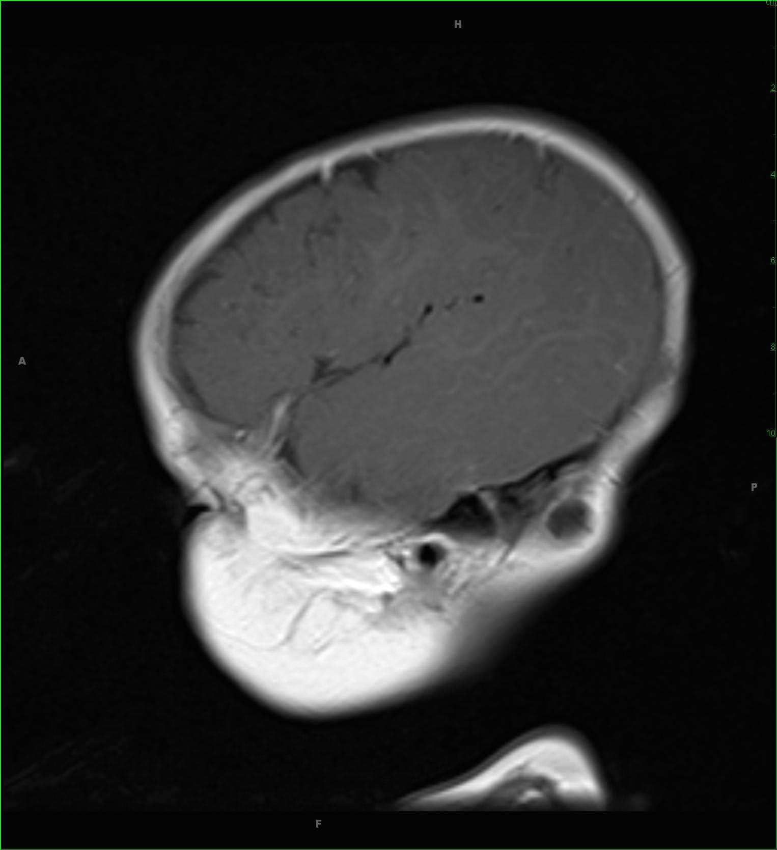 Dermoid, retroauricular scalp - CTisus CT Scan