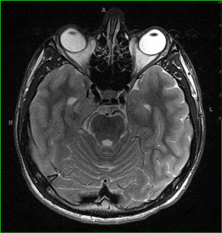 Ewing Sarcoma, right temporal bone - CTisus CT Scan