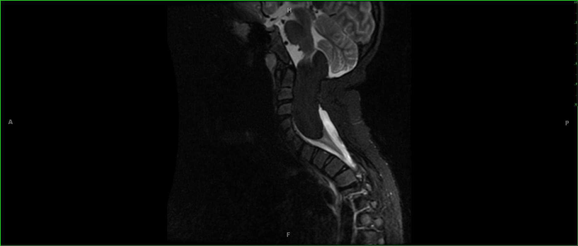 Spinal Lipoma, Cervical - CTisus CT Scan