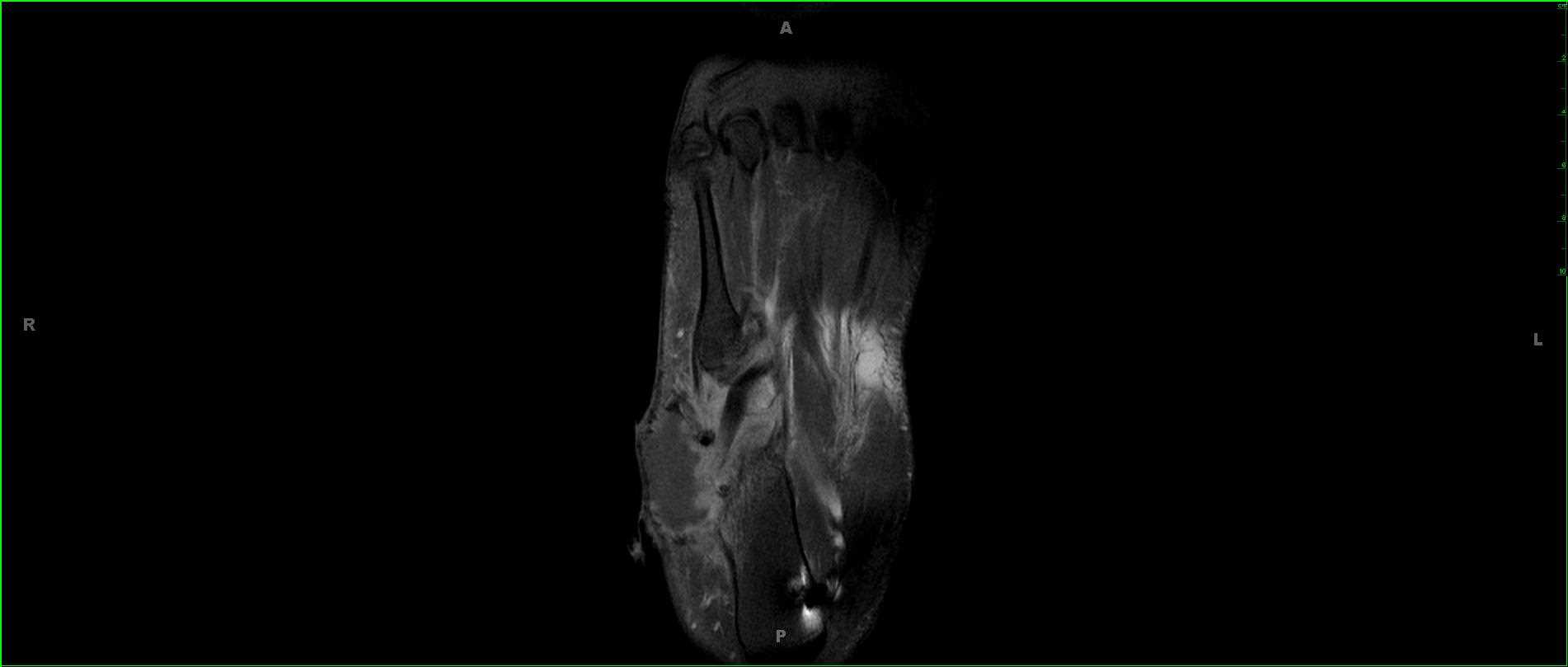 Synovial Sarcoma, Foot - CTisus CT Scan