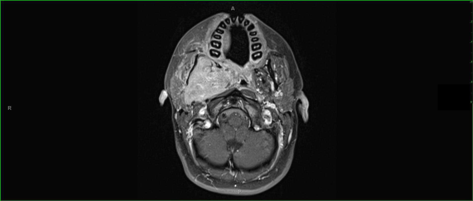 Rhabdomyosarcoma, Masticator Space - CTisus CT Scan