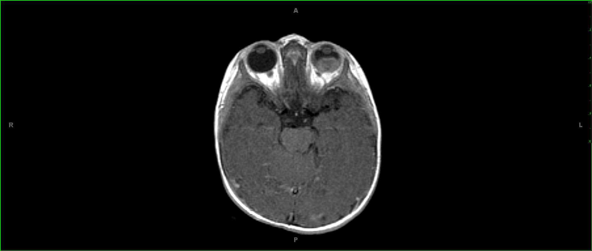 Retinoblastoma - CTisus CT Scan