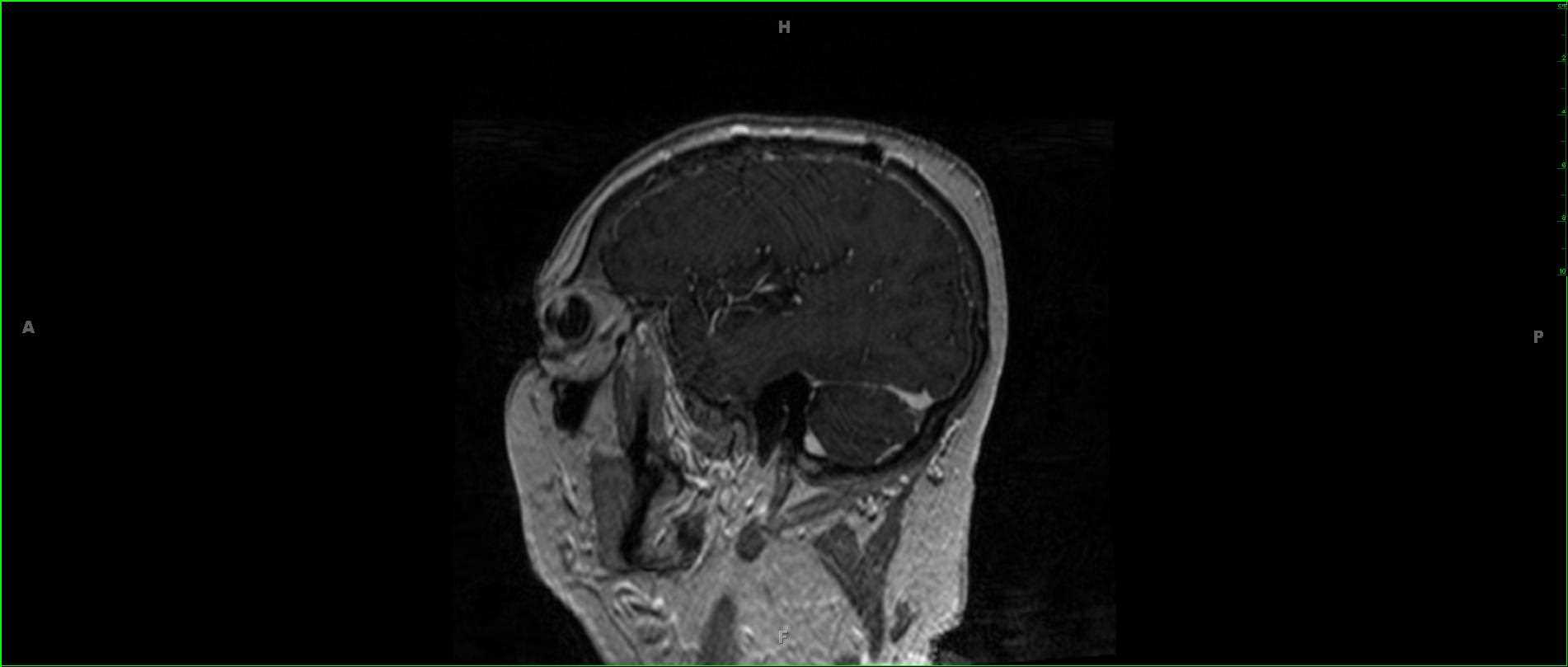 Metastatic Melanoma, with ciliary body (globe) involvement. - CTisus CT Scan