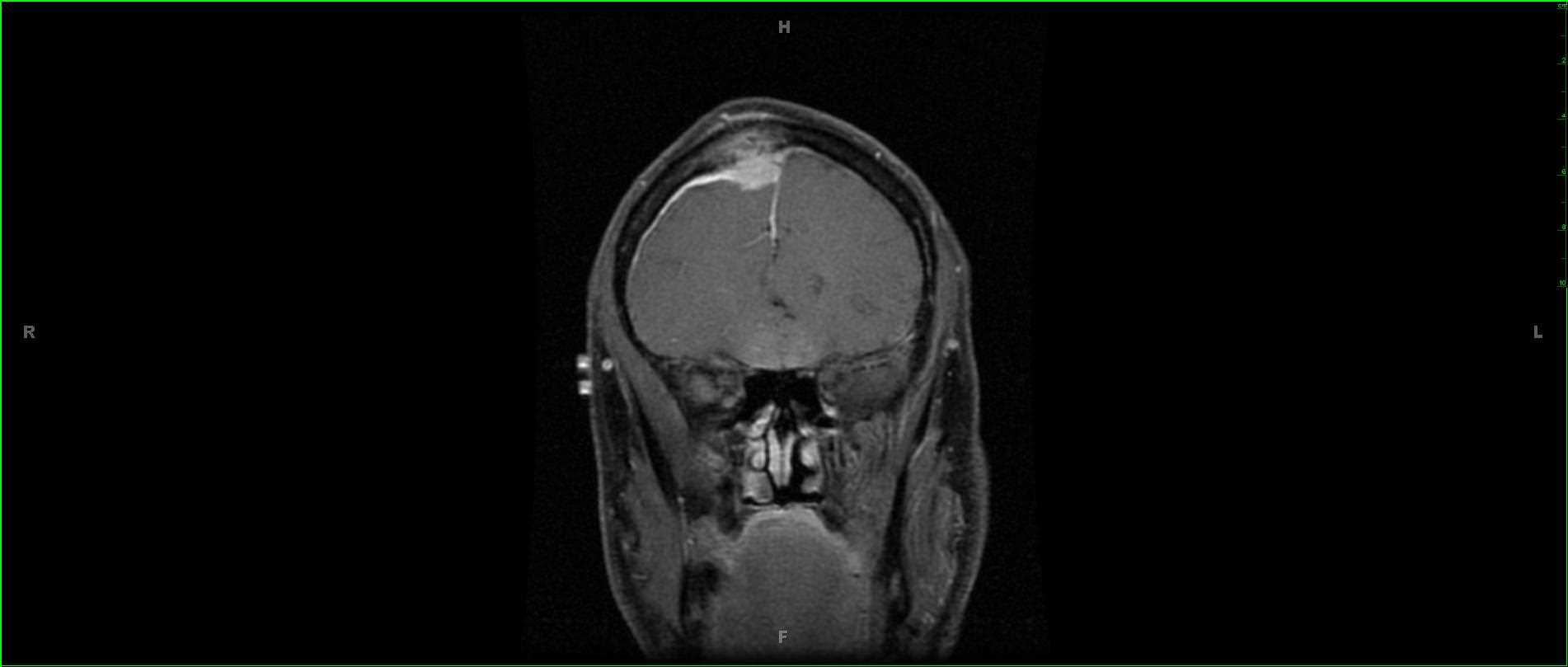Intra-osseous Meningioma and Subgaleal Invasion - Neuro MR Case Studies