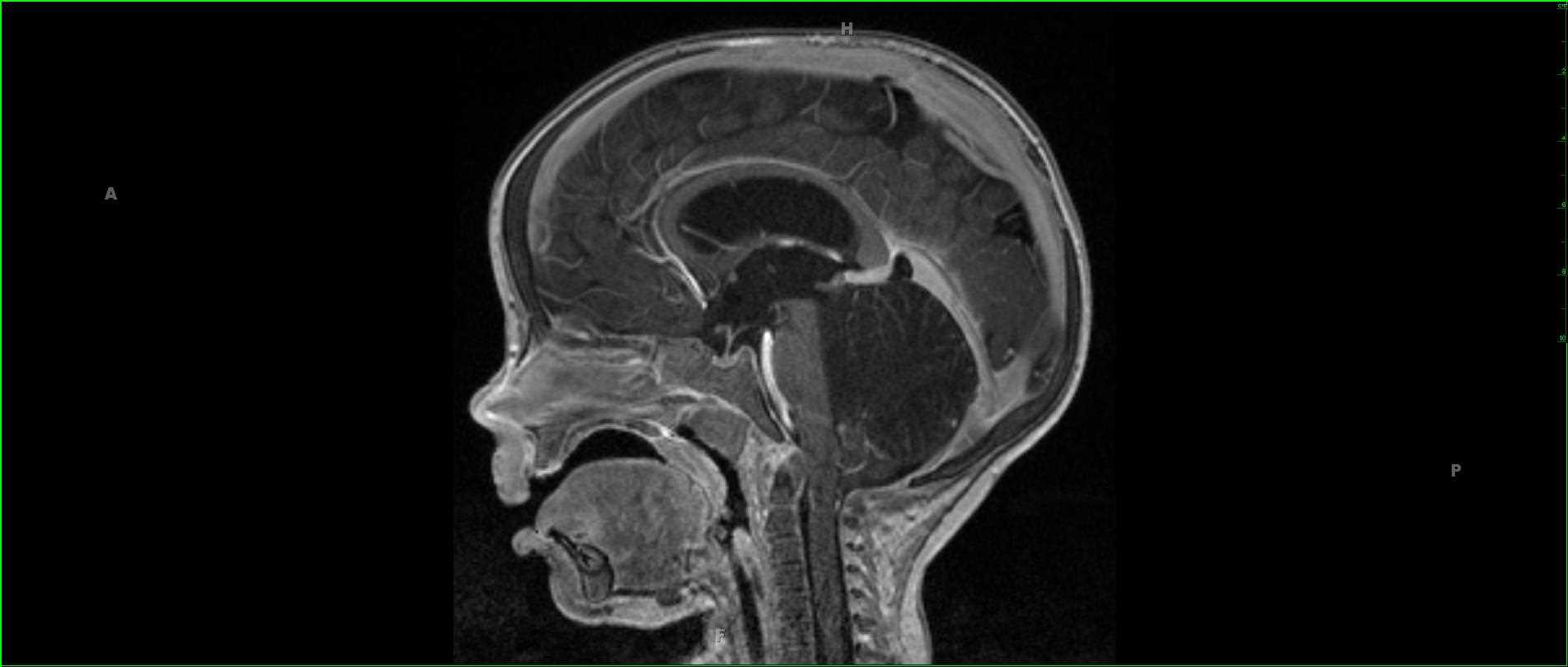 Lhermitte-Duclos - CTisus CT Scan