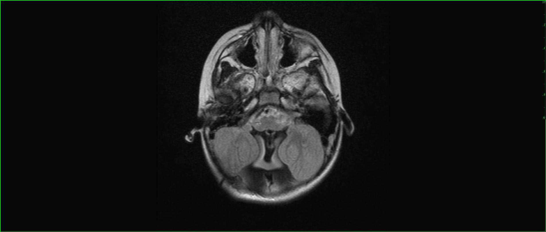 Dandy-Walker Malformation - CTisus CT Scan