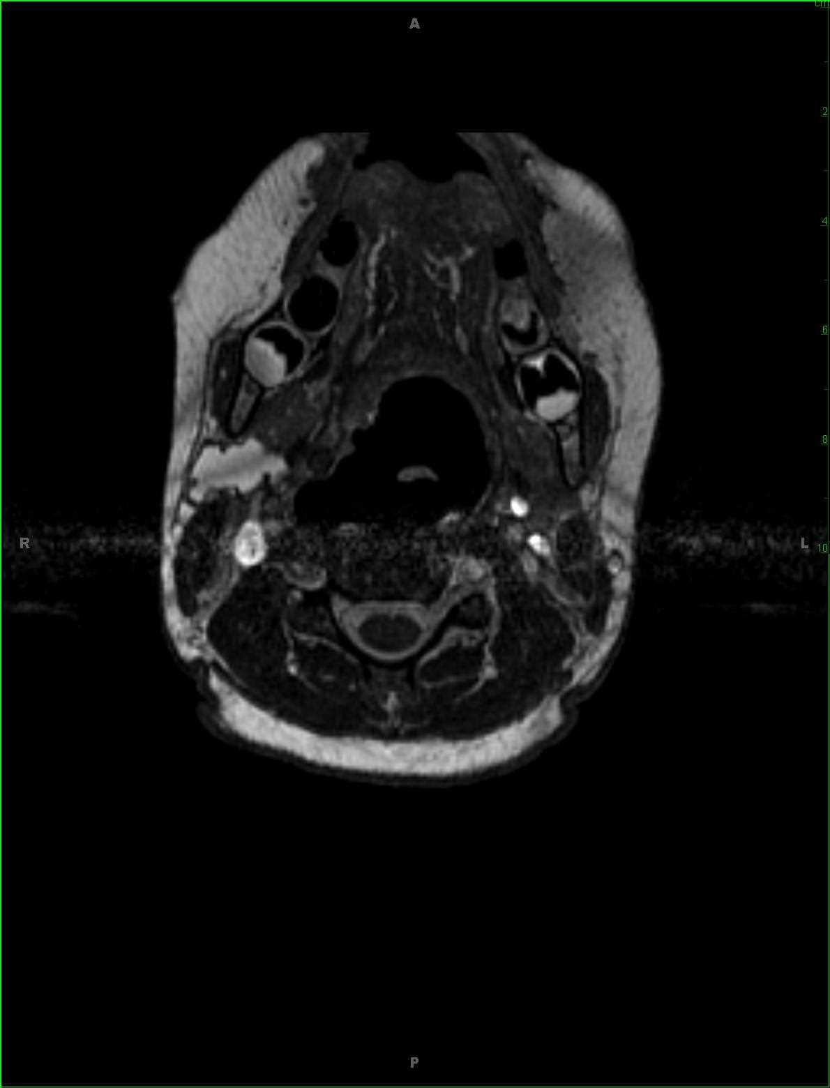 Second Branchial Cleft Cyst, with Rupture - CTisus CT Scan